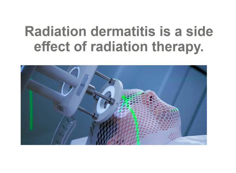 Radiation dermatitis