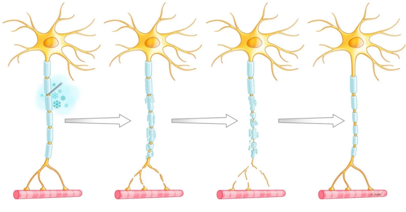 Selective Minimally Invasive Cryoablation as a Treatment for Premature Ejaculation