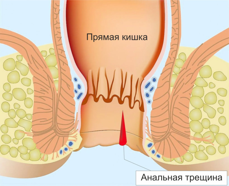 Anal fissure