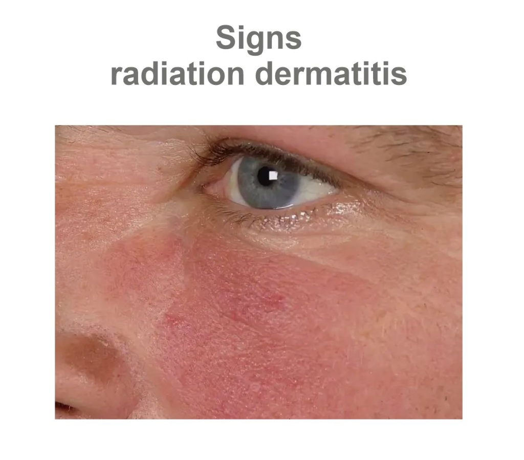 RADIATION DERMATITIS