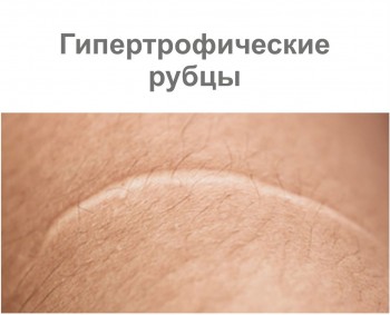 Гипертрофические шрамы