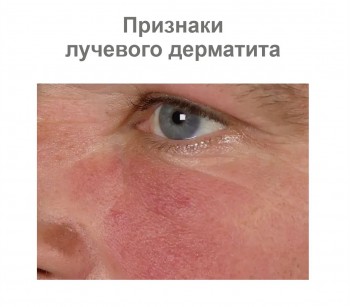 лучевой дерматит