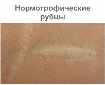 Нормотрофические рубцы