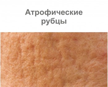 Атрофические рубцы