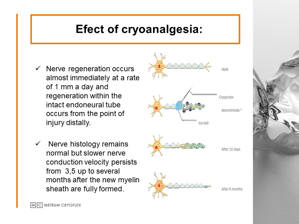 CRYOABLATION OF PENILE NERVES FOR PREMATURE EJACULATION TREATMENT: HOW IT WORKS AND WHY IT’S SAFE.