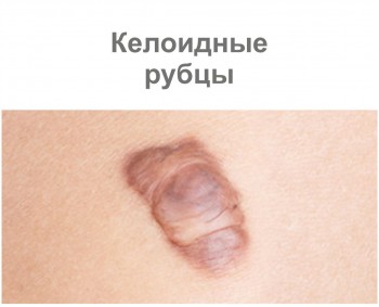 Келоидные рубцы