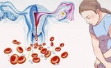 криоабляция эндометрия при маточных кровотечениях (часть 1) - фото - 1
