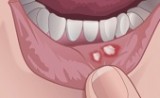 mucositis - фото - 1