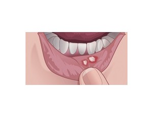 mucositis - фото - 1