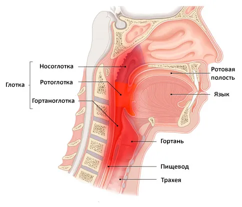 Фарингит Фарингит