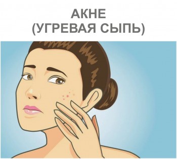 АКНЕ (УГРЕВАЯ СЫПЬ)