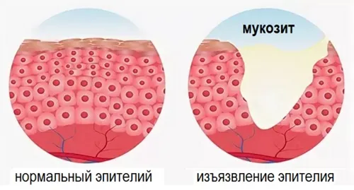 Мукозит Мукозит