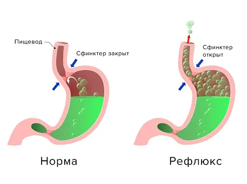Эзофагель или Альфазокс Эзофагель или Альфазокс