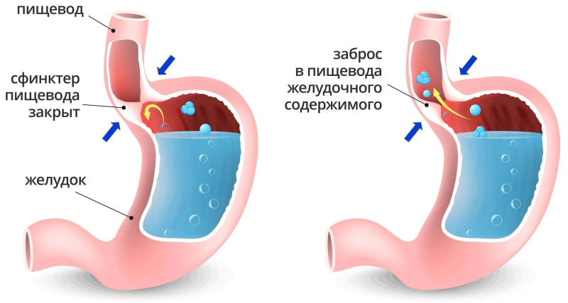Гастроэзофагеальный рефлюкс
