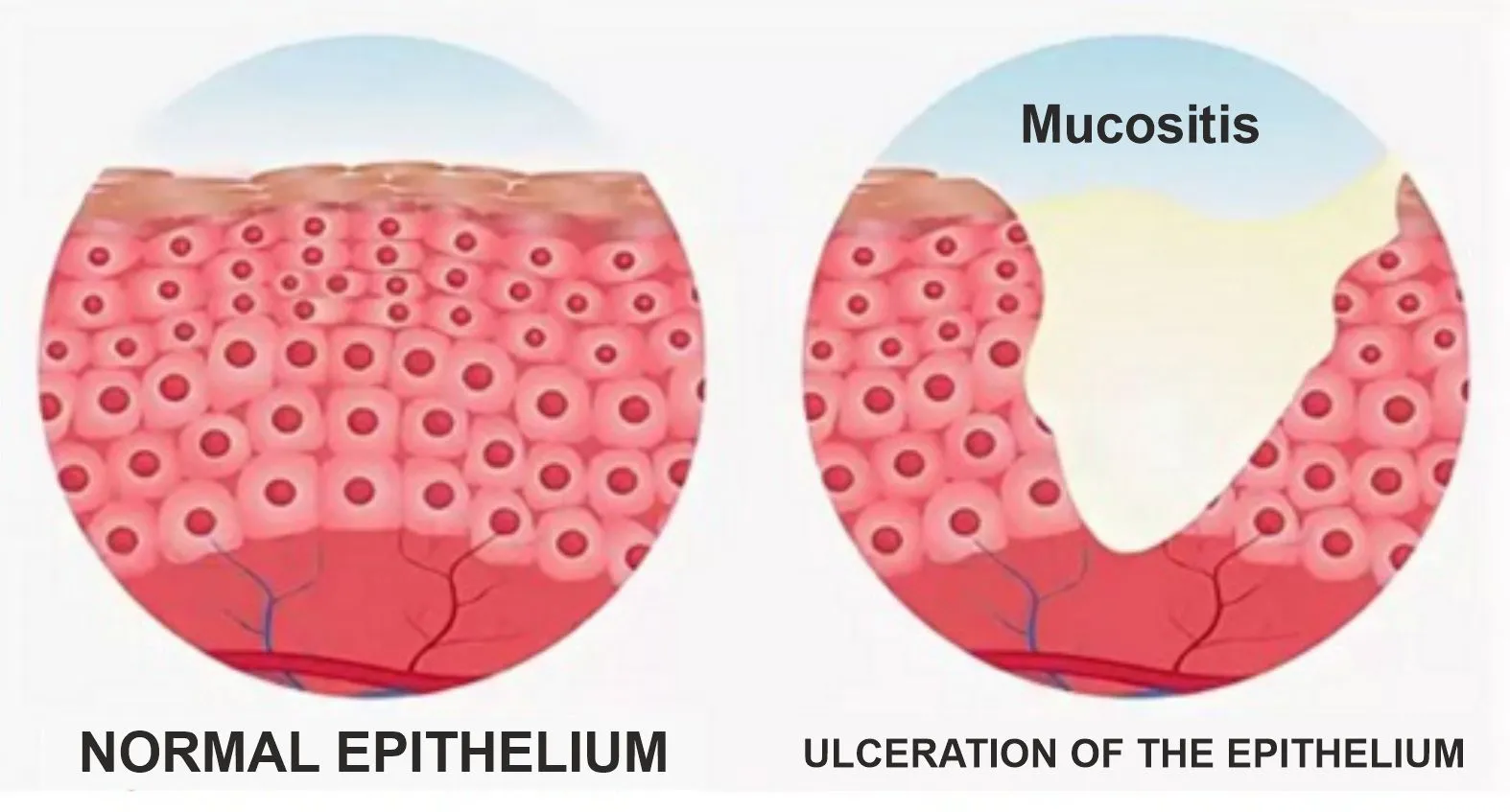 MUCOSITIS MUCOSITIS
