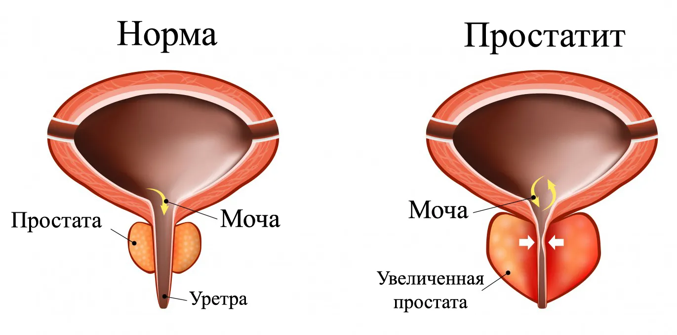 Простатит Простатит
