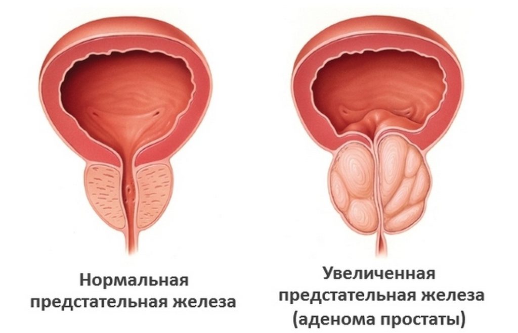  Аденома простаты 