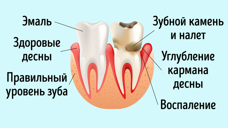 Гингивит