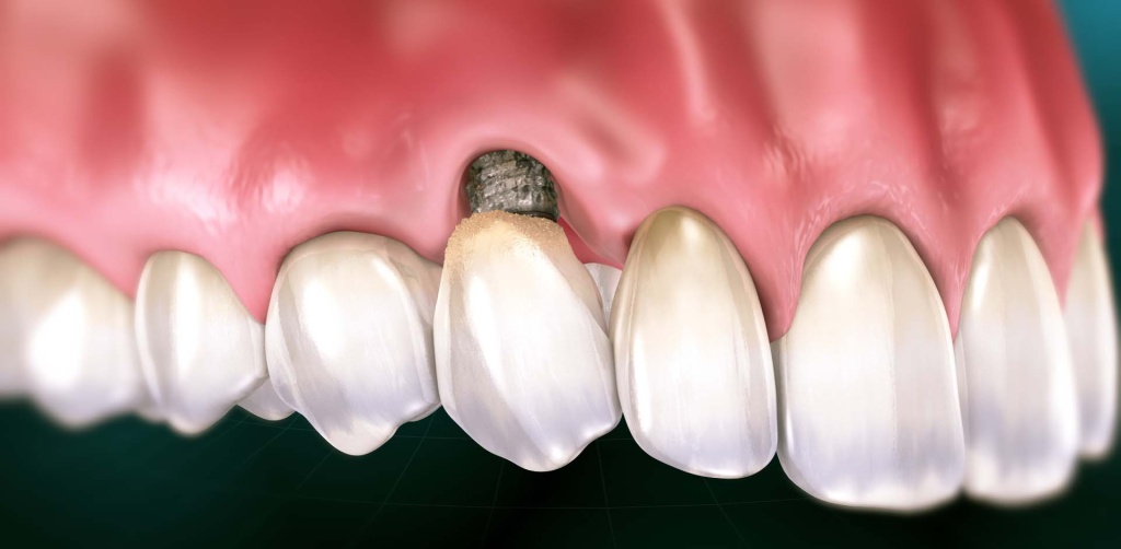 MUCOSITIS