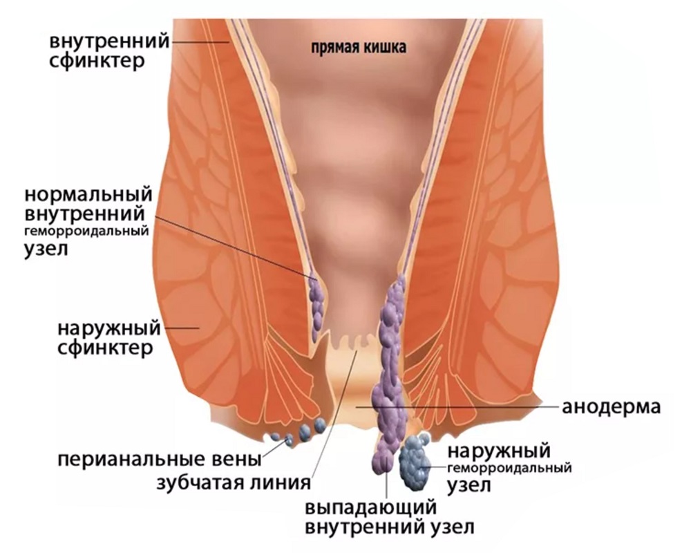 Геморрой