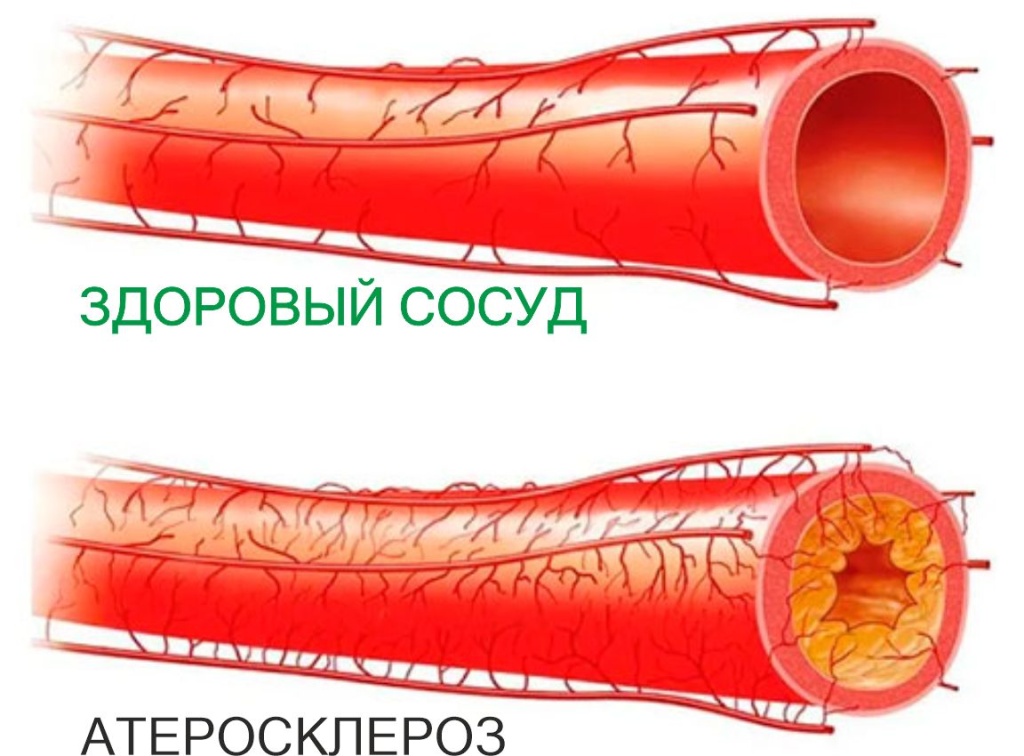 ateroskleroz-1.jpg